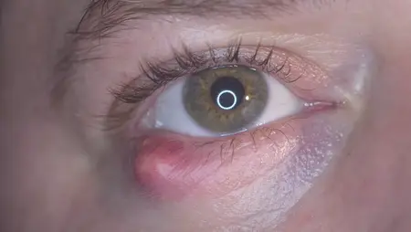 How to Get Rid of a Stye